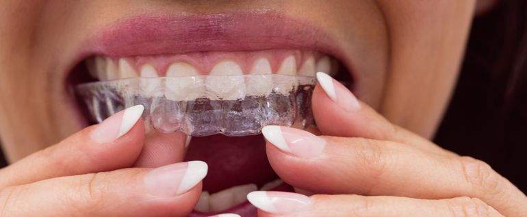 tooth aligner treatment in Ghatkopar East