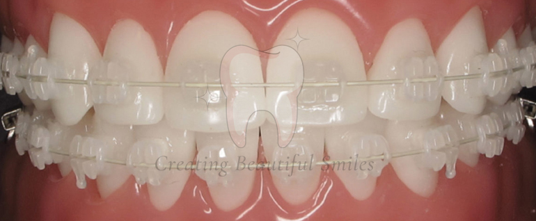 tooth aligner treatment in Ghatkopar East