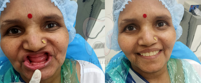 tooth aligner treatment in bandra west