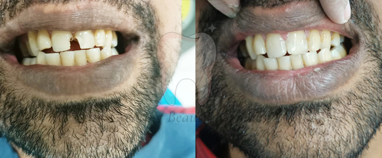 tooth aligner treatment in bandra west