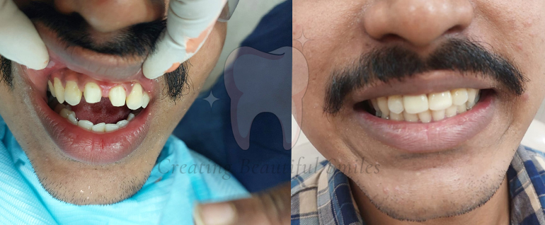 tooth aligner treatment in bandra west