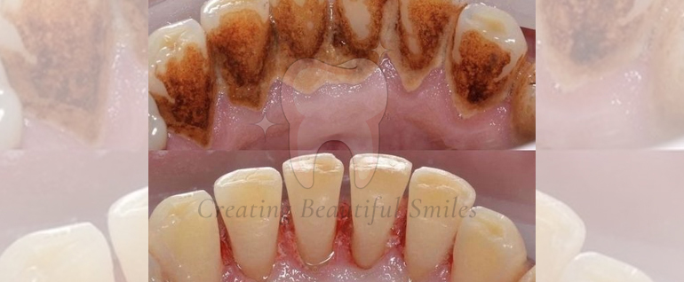 tooth aligner treatment in bandra west