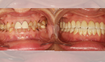 dental filling clinic in bandra west