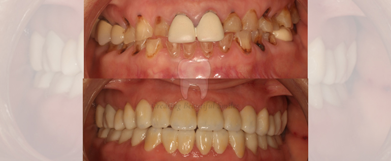 tooth aligner treatment in bandra west