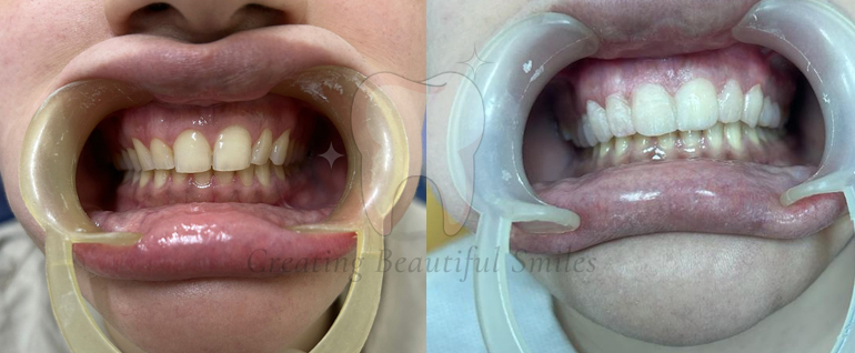 tooth aligner treatment in bandra west